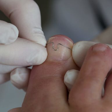 Nagelbeugel bij Podotherapiepraktijk Wouters