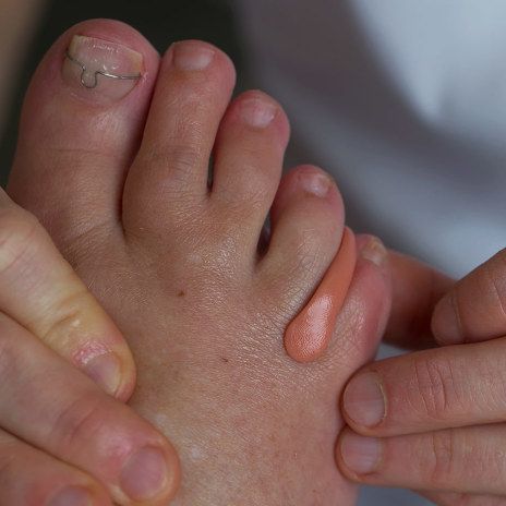 Nagelbeugel of prothese bij Podotherapiepraktijk Wouters